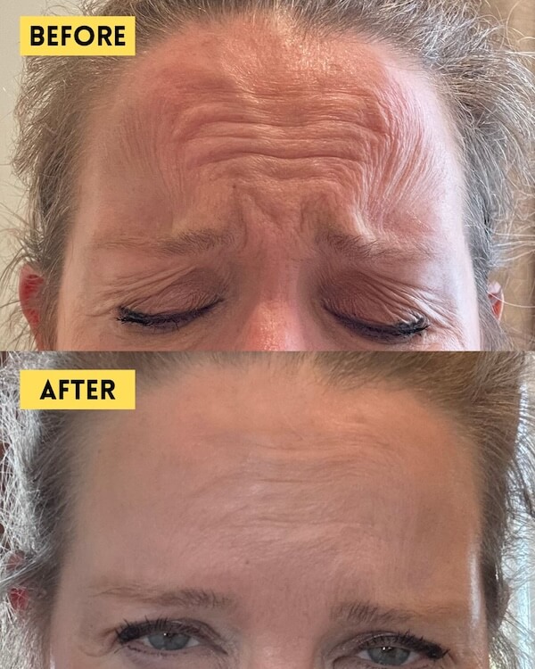 Frown lines before and after Botox treatment