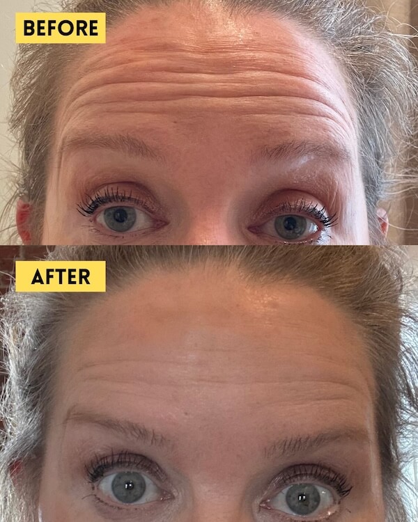 Forehead lines before and after Botox treatment