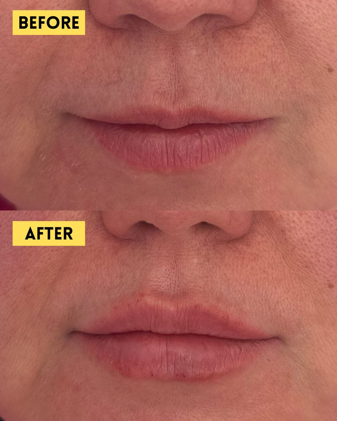 Lip flip before and after Botox treatment