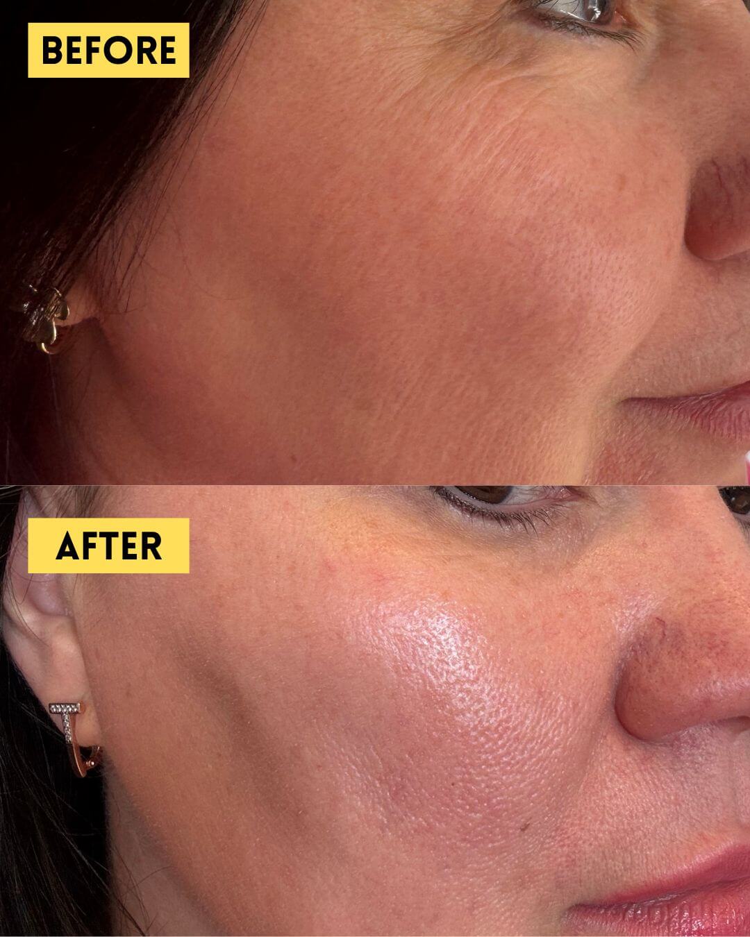 Skinvive before and after treatment