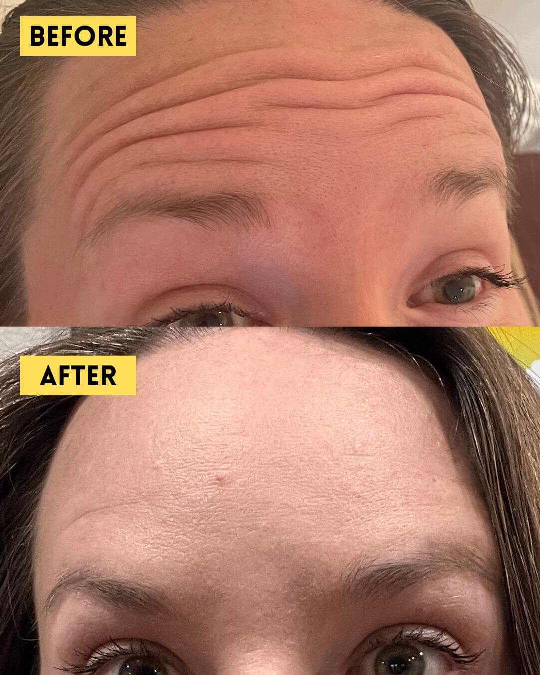 Horizontal forehead lines before and after Botox, patient showing softened lines with natural open forehead