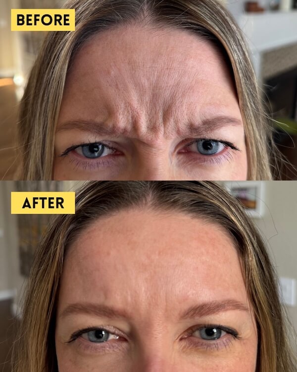 Frown lines before and after Botox treatment