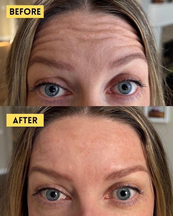 Forehead lines before and after Botox treatment
