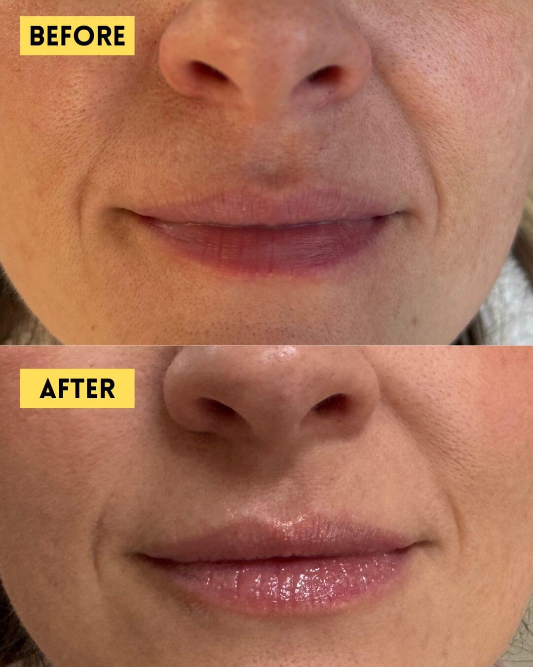 Lip flip before and after Botox treatment