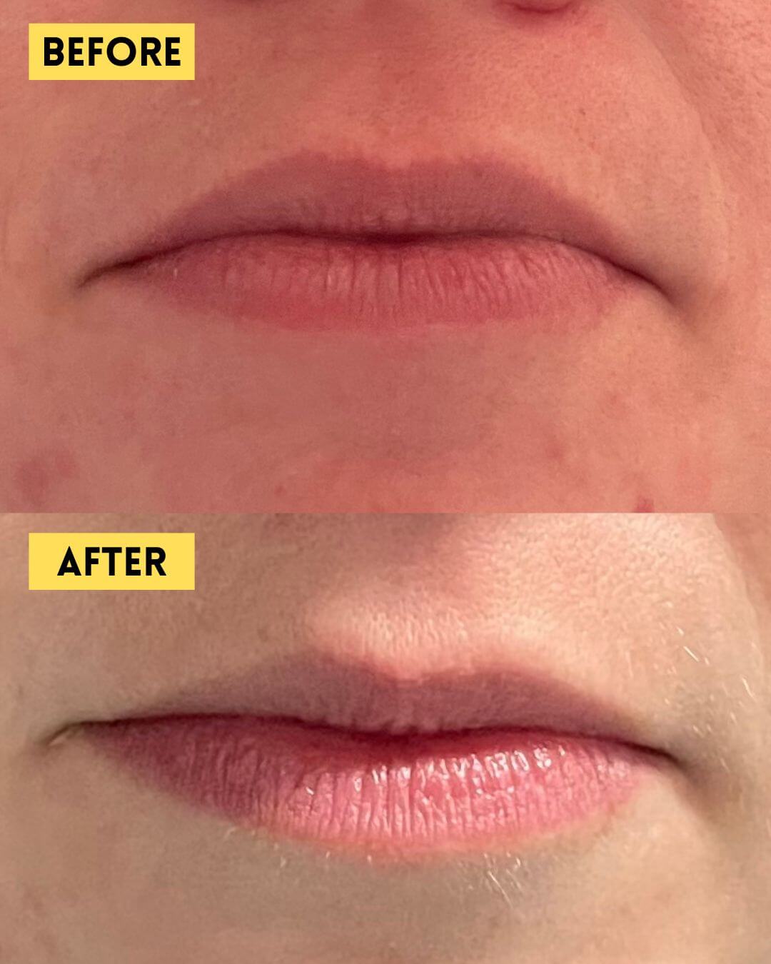 Lip flip before and after Botox treatment