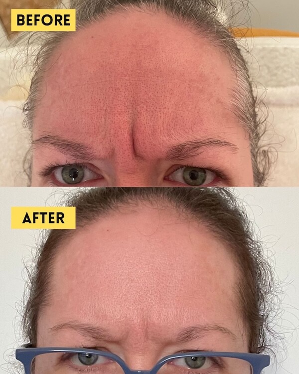 Frown lines before and after Botox treatment
