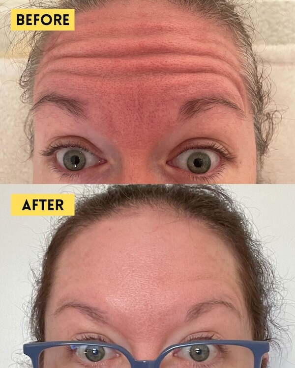 Forehead lines before and after Botox treatment
