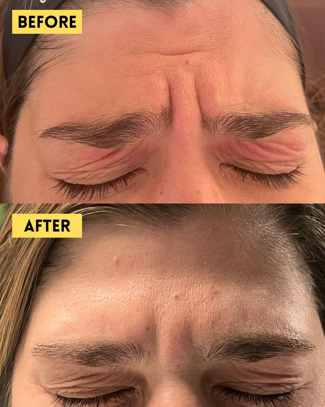 Frown lines before and after Botox, patient showing relaxed glabellar lines with tension between brows released