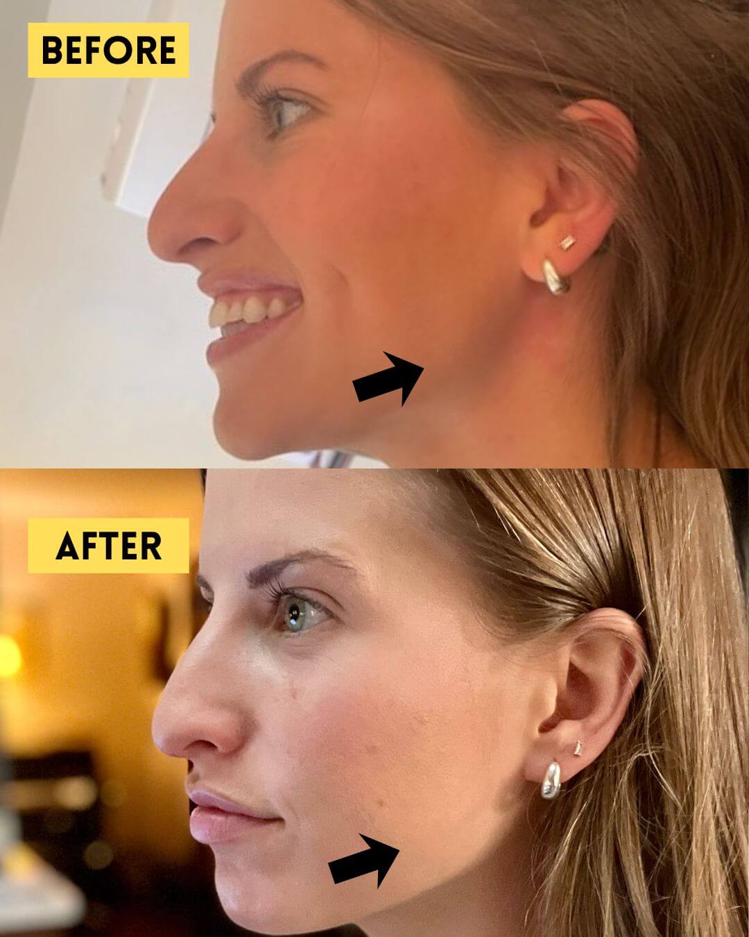 Masseter before and after Botox treatment