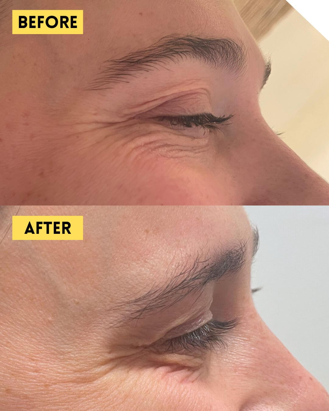 Crow’s feet before and after Botox treatment