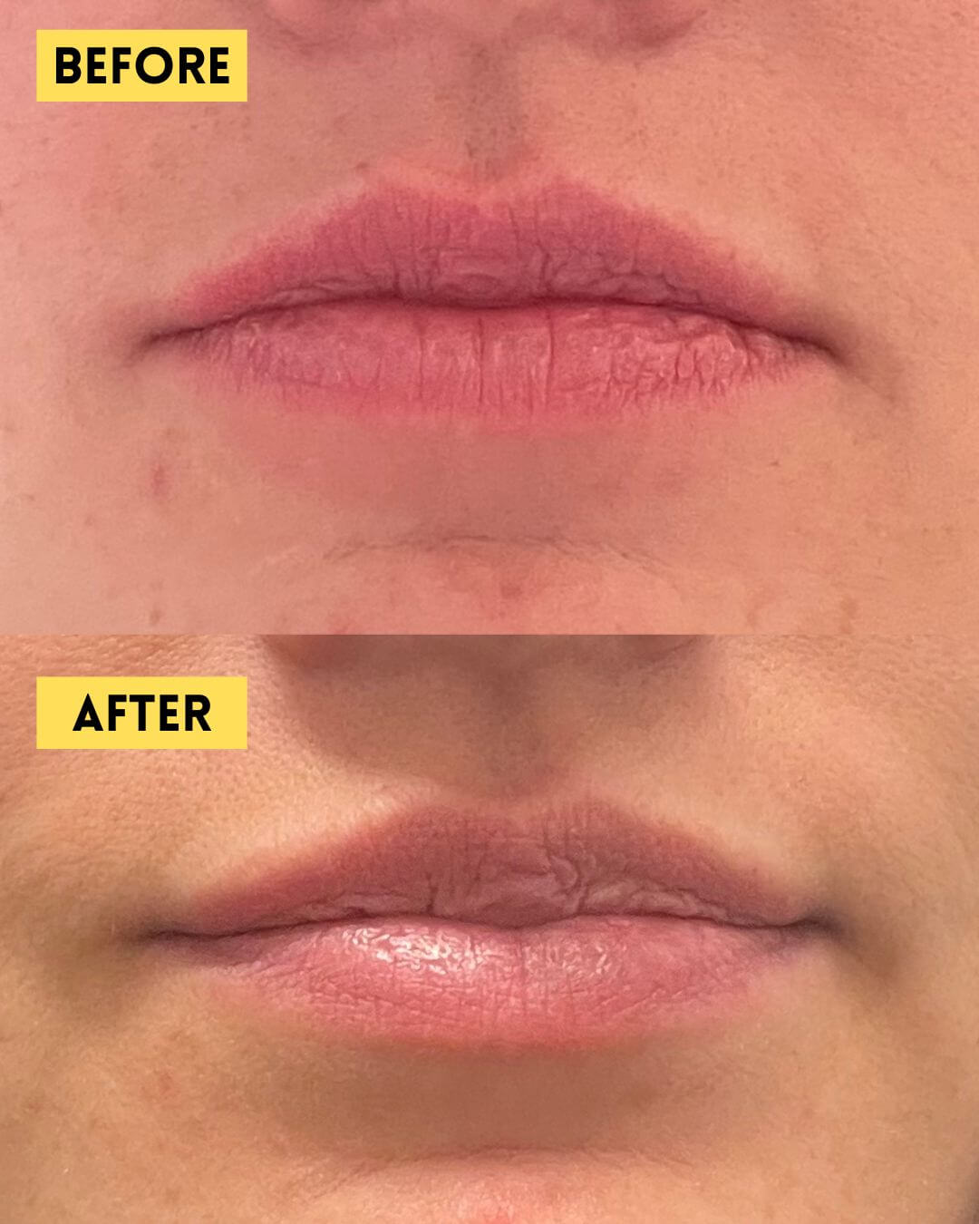 Lip flip before and after Botox treatment